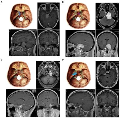 Analysis of Approaches in the Microsurgical Treatment of 102 Cases of Petroclival Meningioma in a Single Center
